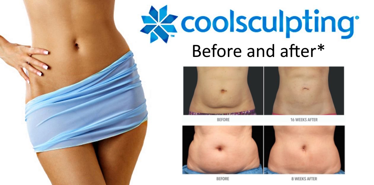 CoolSculpting - Have you seen body contouring results like